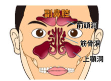副鼻腔炎の原因と症状